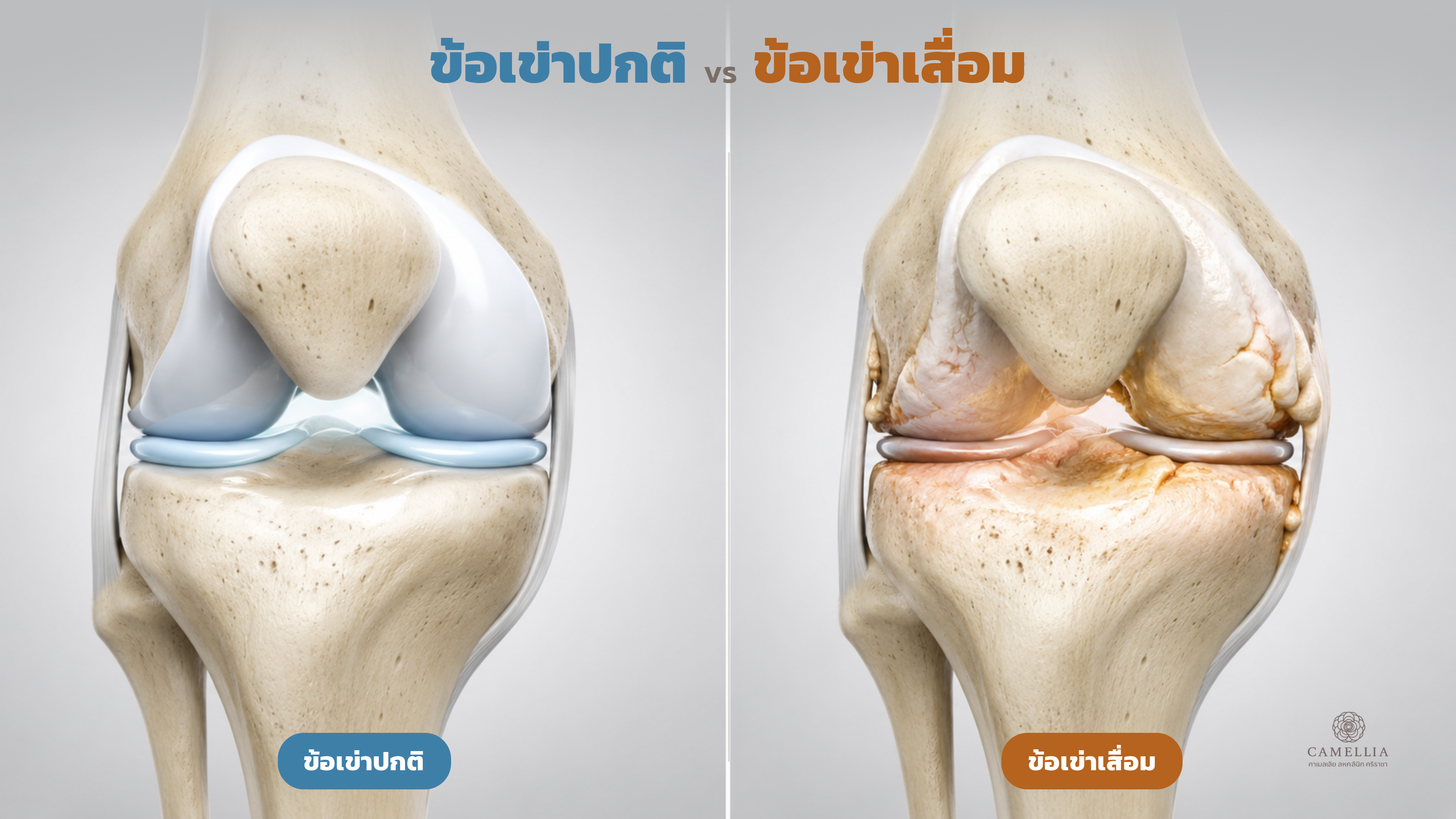 ข้อเข่าปกติกับข้อเข่าเสื่อม ต่างกันอย่างไร?